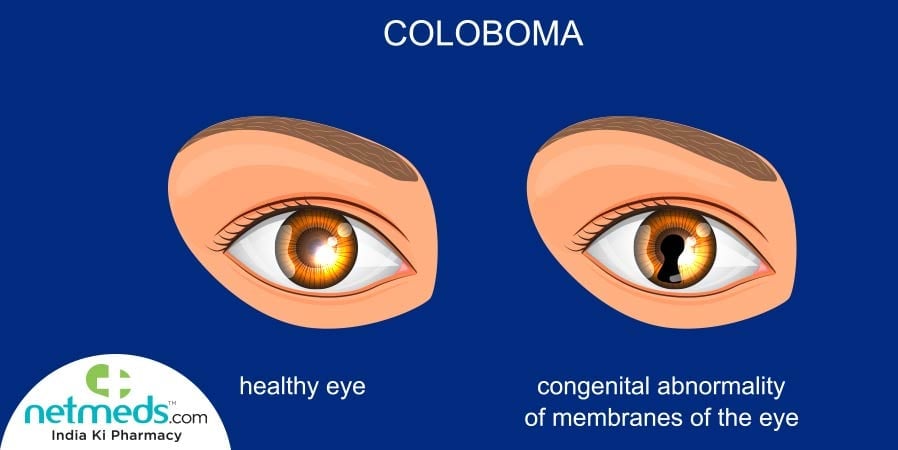 Coloboma