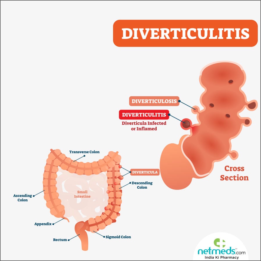 Diverticulitis ailment