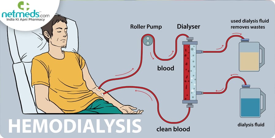 Hemodialysis