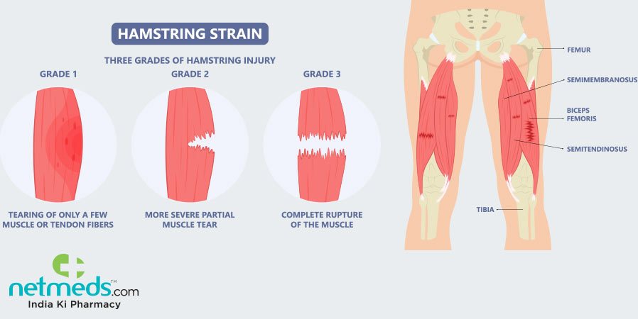Hamstring strain