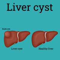Liver Cyst: Causes, Symptoms And Treatment
