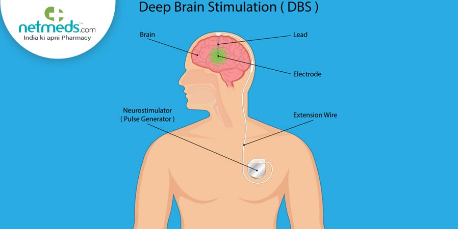 Deep brain stimulation