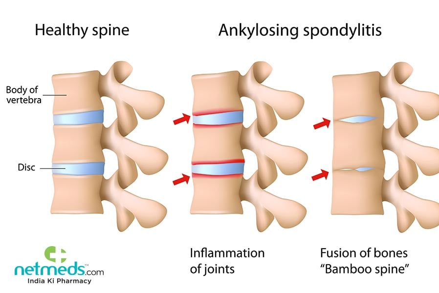 ankylosing spondylitis