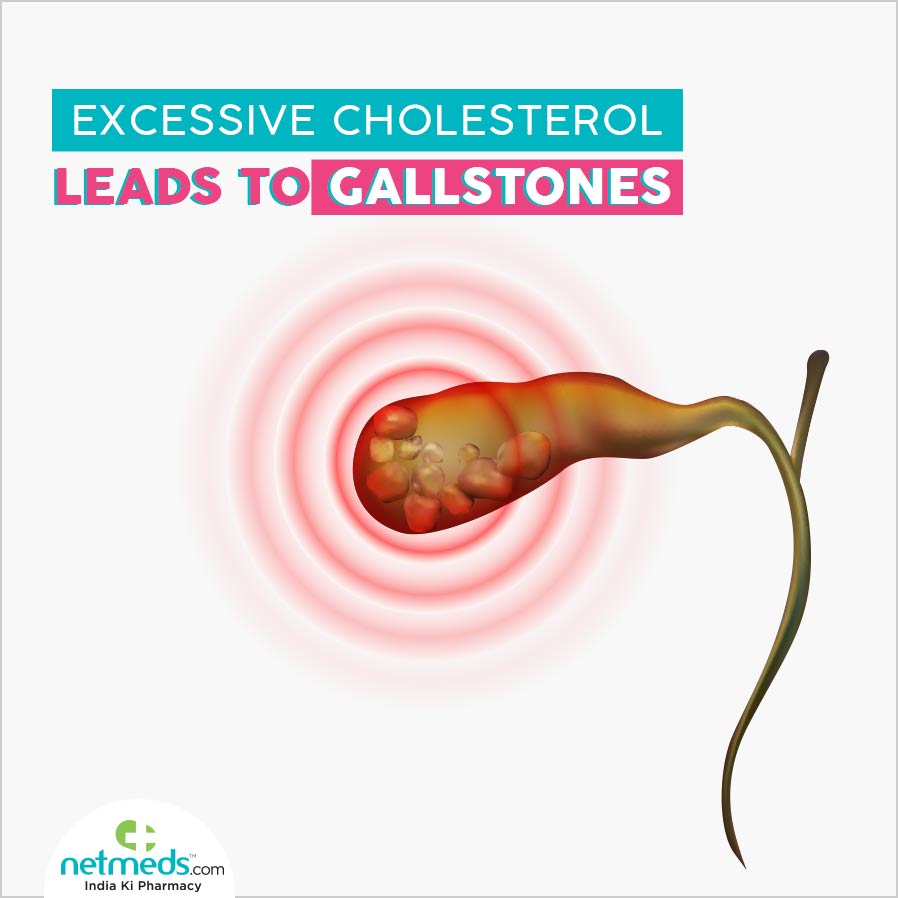 Excessive Cholesterol Leads to Gallstones