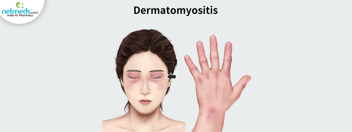 dermatomyositis