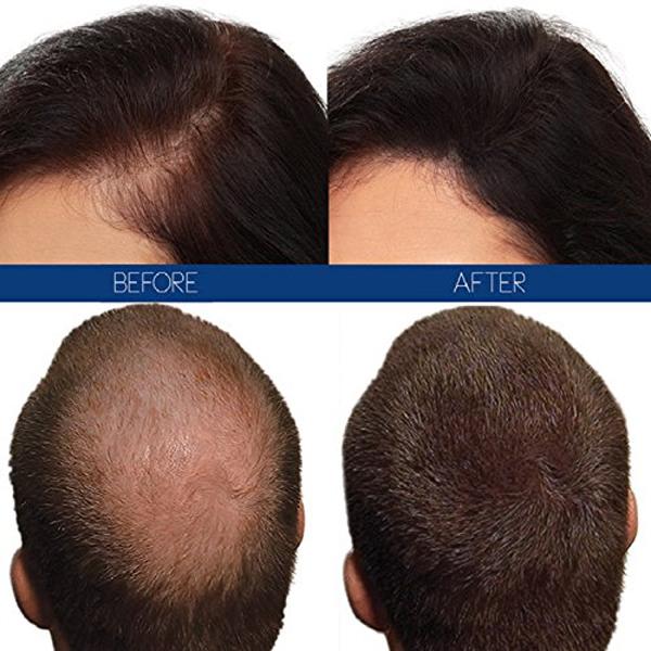 Hair4Real Hair Building Fiber Powder - Dark Brown (Pack of 2 X 25 ml) - Powder