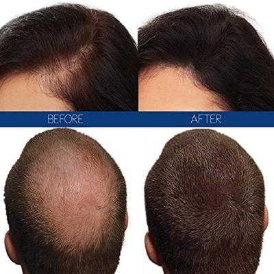 Hair4Real Hair Building Fiber Powder - Dark Brown (Pack of 2 X 25 ml) - Powder