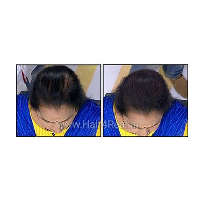 Hair4Real Hair Building Fiber Powder - Dark Brown (Pack of 2 X 25 ml) - Powder