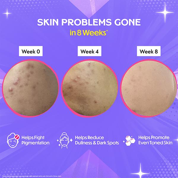 Chicnutrix Glow - Glutathione & Vitamin C For Skin Radiance - Strawberry & Lemon Flavour 20 Tablets 1's - Hair & Skin