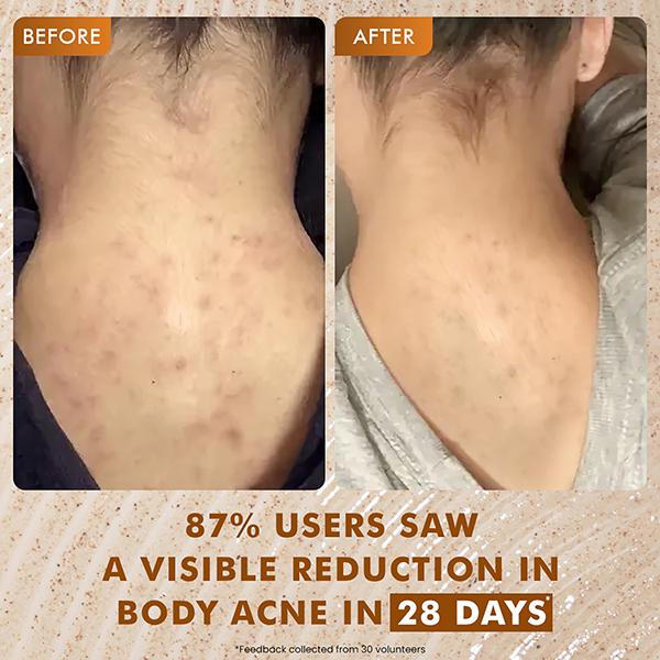 MCaffeine 7% Exfoliating Body Wash- 1% Salicylic 2% Lactic Acid, Shower Gel to Reduce Body Acne 300 ml - Shower Gels & Body Wash