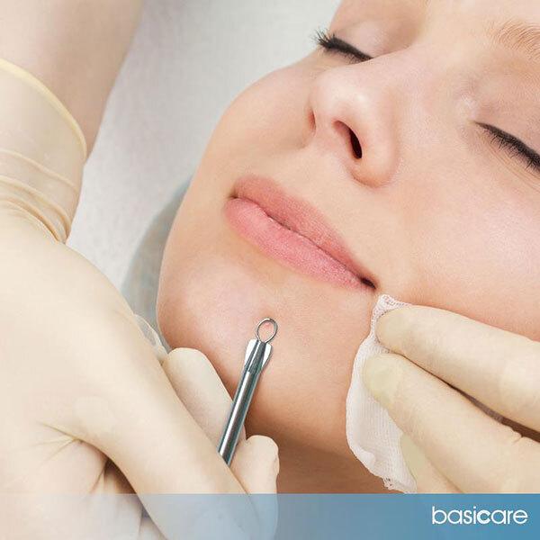 Basicare Black Head Remover Loop/L 1's - Face Wash & Cleansers