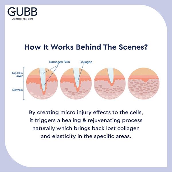 Gubb Derma Roller 540 Needles 0.5 mm 1's - Derma Rollers
