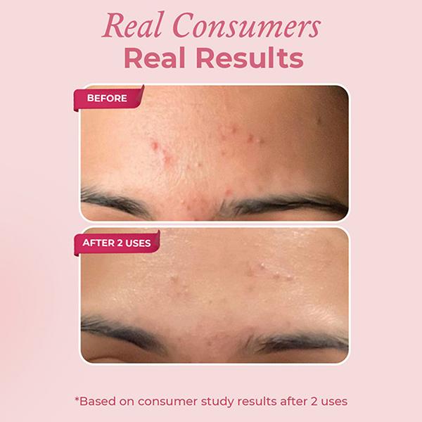 The Pink Foundry Overnight Acne Spot Corrector 15 ml - Skin-Treatment