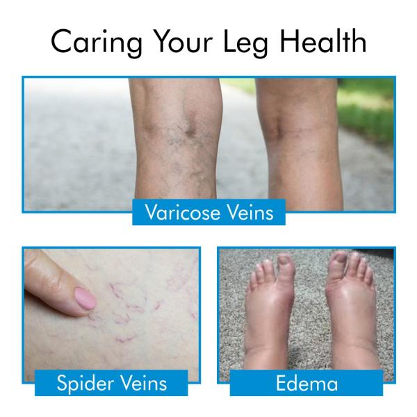 AccuSure Varicose Vein Stockings (XXL) 1's - Knee/Leg Supports
