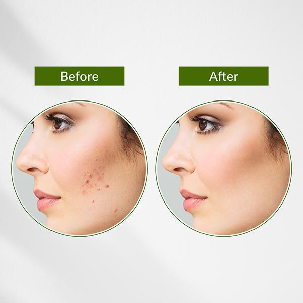 Lotus Botanicals Neem, Tulsi, Salicylic Acid Anti-Acne Purifying Face Gel, For Acne Prone Skin 50 gm - Face Moisturizers
