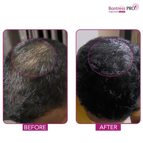 Bontress Pro Plus Scalp Serum 30 ml - Hair Serums