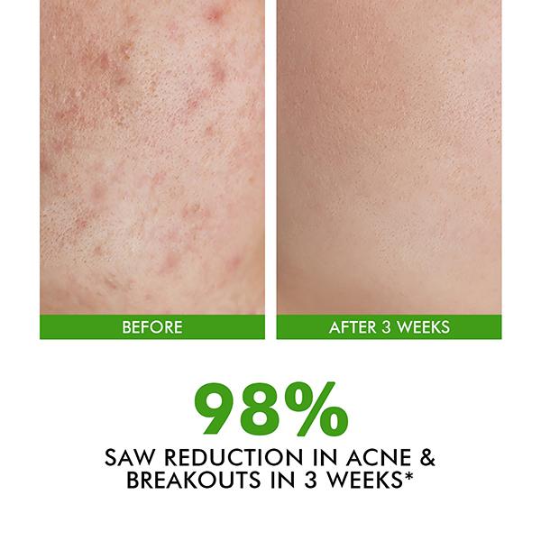 Conscious Chemist Acne Management & Prevention Serum 2% Salicylic Acid & Allantoin 30 ml - Face Serum