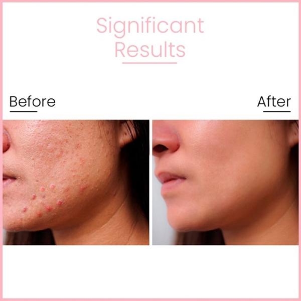 Anveya Goodbye Acne Serum With Niacinamide, Azelaic Acid & Hyaluronic Acid 30 ml - Face Serum