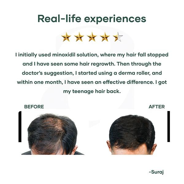 Mars By GHC Derma Roller With 540 Titanium Alloy Micro Needles 340 gm - Derma Rollers