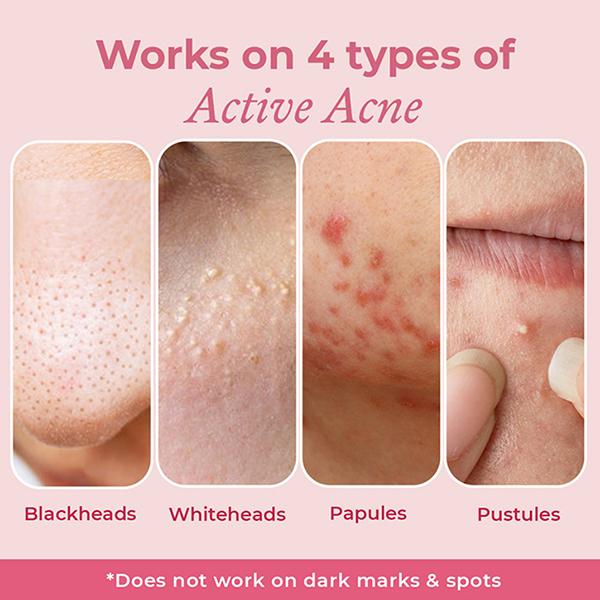 The Pink Foundry Overnight Acne Spot Corrector 15 ml - Skin-Treatment