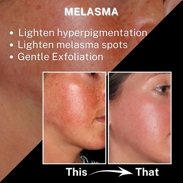 House of Beauty Pigmentation Oil For Pigmented Skin, Reduces Melanin, Uneven Skin Tone 30ml - Face Oils