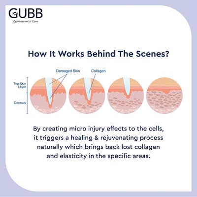 Gubb Derma Roller - Red 540 Needles 0.5mm 1's - Derma Rollers