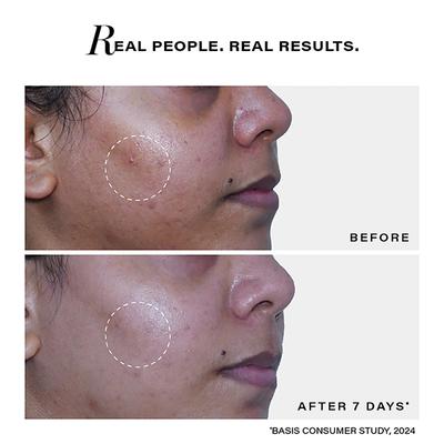 Novology Acne Clearing Cleanser for Acne, Whiteheads & Blackheads - Suitable for Sensitive Skin 150 gm - Face Wash & Cleansers