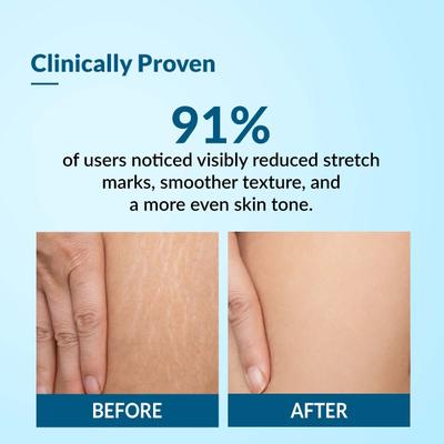 Fixderma Strallium Stretch Mark Cream 75 gm - Stretch Mark Cream