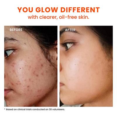 Foxtale 12% Niacinamide Serum with Azelaic Acid for Oil Control & Brightening 30ml - Face Serum