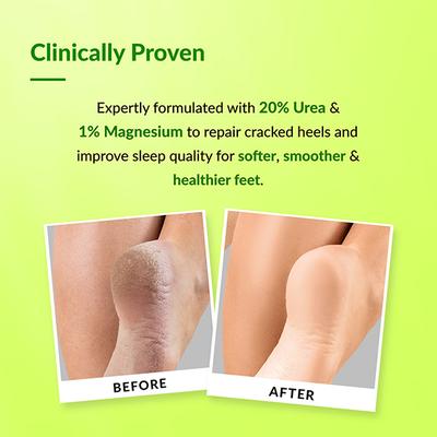 Fixderma Foobetik Foot Roll On For Dry & Cracked Heels Helps Repair and Moisturise Cracked Heels 60 ml - Foot Creams & Lotions