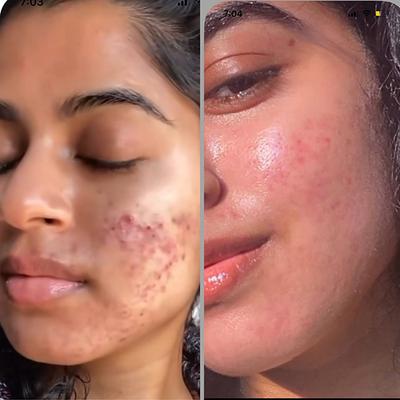 House of Beauty Acne Drying Serum For Pimpled, Oily & Open Pores Skin with Salicylic Acid 30ml - Face Serum