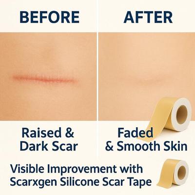 Scarxgen Silicone Gel Sheet (4cm x 150cm) 1 's - Bandages