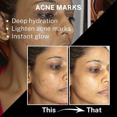 House of Beauty Acne Drying Serum For Pimpled, Oily & Open Pores Skin with Salicylic Acid 30ml - Face Serum