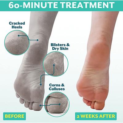 Patchology Poshpeel Pedi Cure 2's - Others
