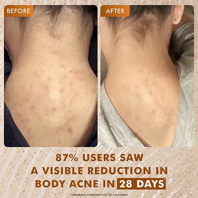 MCaffeine 7% Exfoliating Body Wash- 1% Salicylic 2% Lactic Acid, Shower Gel to Reduce Body Acne 300 ml - Shower Gels & Body Wash