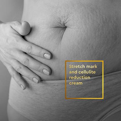 VLCC Clinic Stretch Mark Cream 100 gm - Lotions & Creams