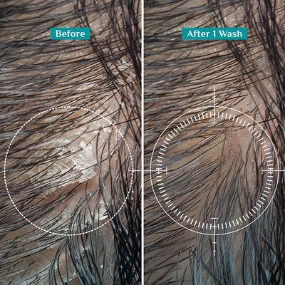 Pilgrim Australian Tea Tree & Salicylic Acid Non-Drying Anti-Dandruff Shampoo 650 ml - Shampoos