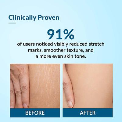 Fixderma Strallium Stretch Mark Cream 75 gm - Stretch Mark Cream