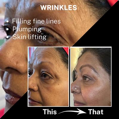 House of Beauty Gold Collagen Roller with Acupressure Point Press For Plumping & Fine Lines 1's - Massagers