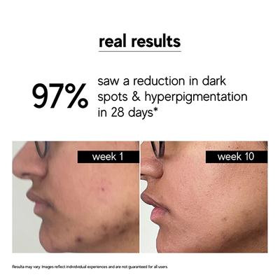 Inde Wild 15% Vitamin C With Turmeric, Niacinamide , Acne Scars, Hyperpigmentation Brightening 30 ml - Face Serum