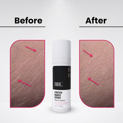 Thriveco Stretch Mark Expert Serum Cream 30 ml - Creams/Oils/Lotions