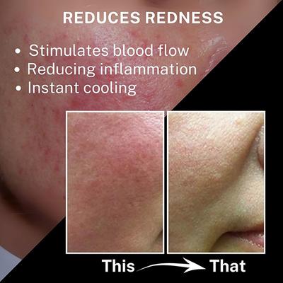 House of Beauty Ice Roller Blue For Dark Circles & Soothes Irritated & Pimpled Skin 1's - Derma Rollers