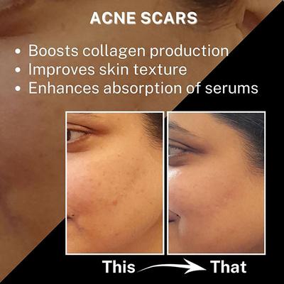 House of Beauty Derma Roller 1.50Mm For Home Use, Improves Hair Growth,Remove Stretchmarks 1's - Derma Rollers