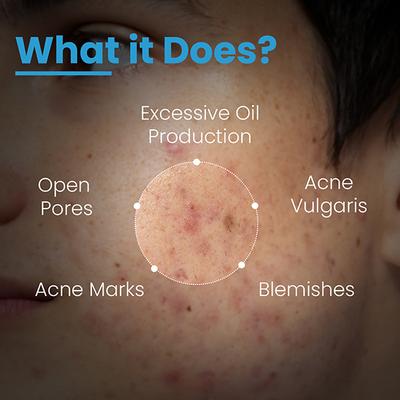 Fixderma Cosmetic Laboratories (FCL) Alpha Beta Acne Face Gel 30 ml - Face Gels