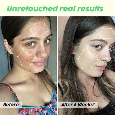 Plix The Plant Fix 10% Niacinamide Jamun Face Serum For Acne Marks & Scars For Unisex 30 ml - Face Serum