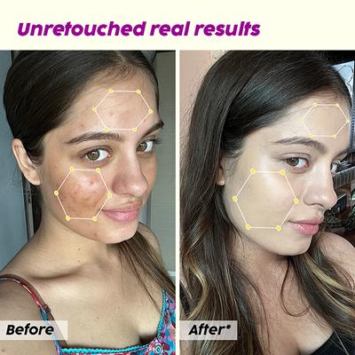 Plix The Plant Fix 10% Niacinamide Jamun Face Serum For Acne Marks & Scars For Unisex 30 ml - Face Serum