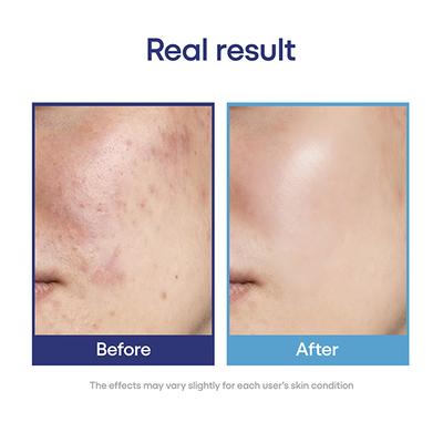 Hyalugel Plus Gel(Topical) 30gm - Dry Skin-Emo