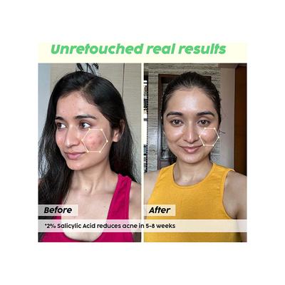 PLIX Jamun Acne Spot Corrector Gel for Reducing Active Acne, Day & Night Gel, Controls Oil & Soothes Inflammation for Men & Women 15 gm - Face Gels