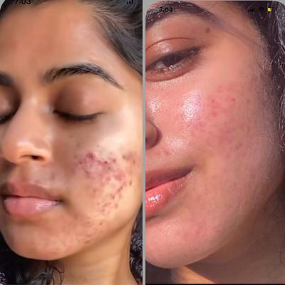 House of Beauty Anti Acne Foaming Facewash For Oily & Combination Skin with Salicylic 100ml - Face Wash & Cleansers