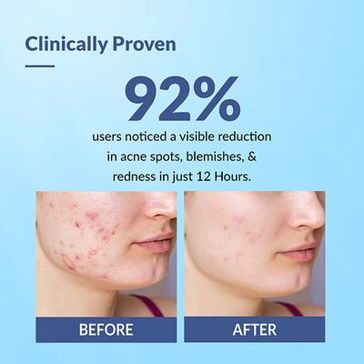 Fixderma Salyzap Acne Spot Corrector Gel with Salicylic Acid & Aczero Reduce Acne Pimples 20 gm - Face Moisturizers